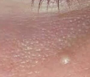cryotherapy-3-before (1)